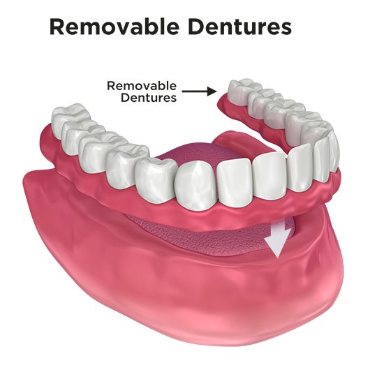 Upper Dentures Without Palate Evansville IN 47714